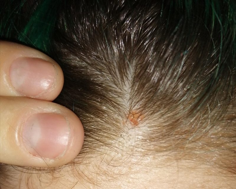 How To Treat Scabs On The Scalp BOS BBQ