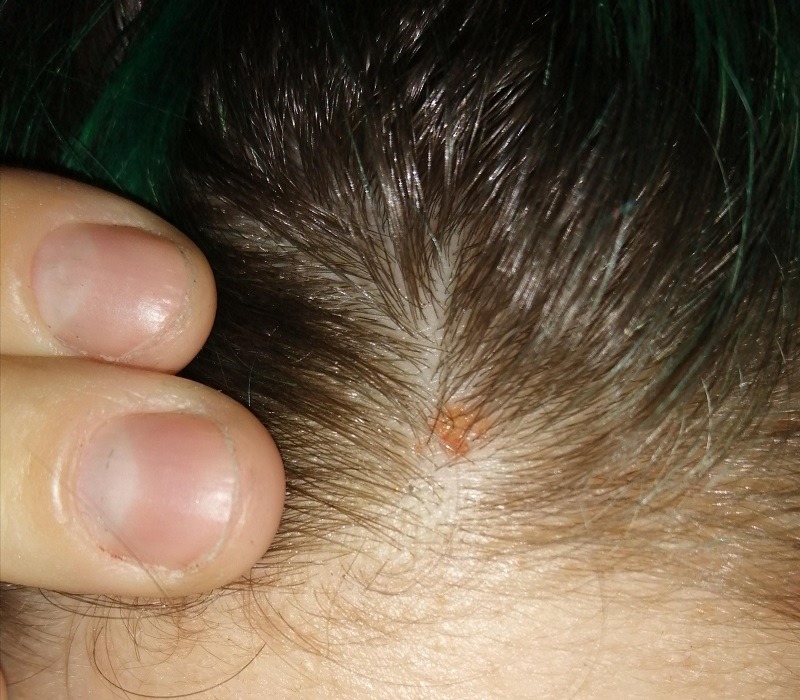 scabs on scalp treatment scabs on scalp treatment